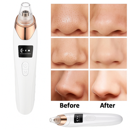 LUMIVIA™ – Electric Acne Pore Cleaner &amp; Blackhead Remover